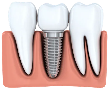 dental implant