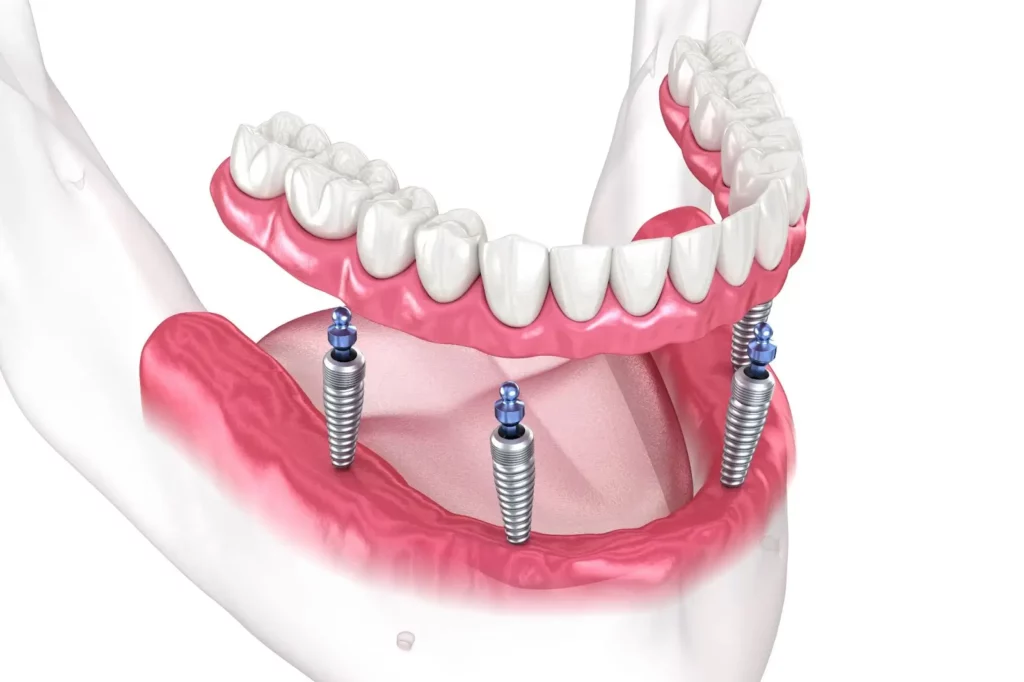 all-on-4 implant illustration