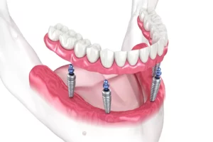 all-on-4 implant illustration